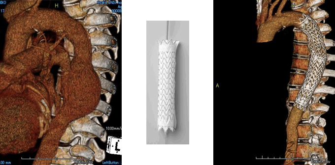 大動脈瘤の3D-CT画像