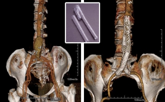大動脈瘤の3D-CT画像