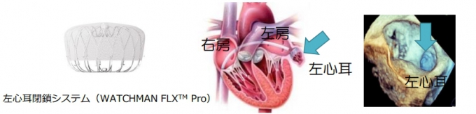 カテーテルを用いた左心耳閉鎖システム