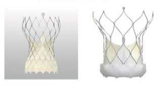 自己拡張型人工弁