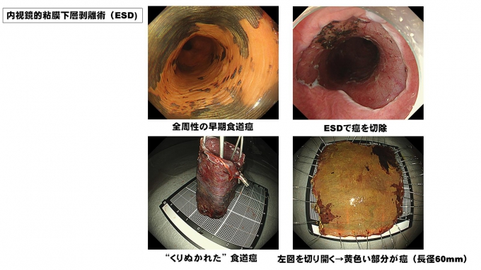 内視鏡的粘膜下層剥離術（ESD）