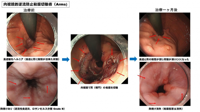 内視鏡的逆流防止粘膜切除術（Arms）