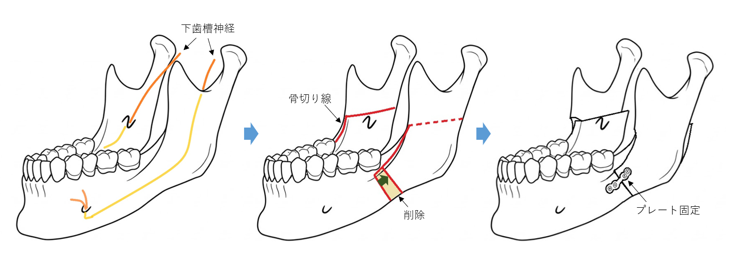 下顎枝矢状分割術の術式