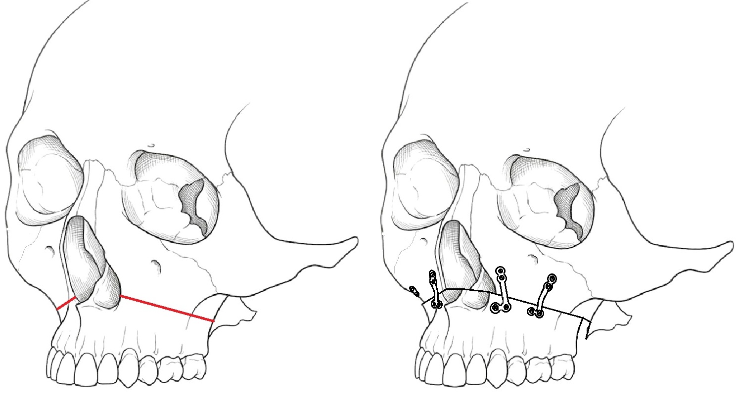 ルフォー1型骨切り術