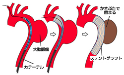 ステント・グラフと治療