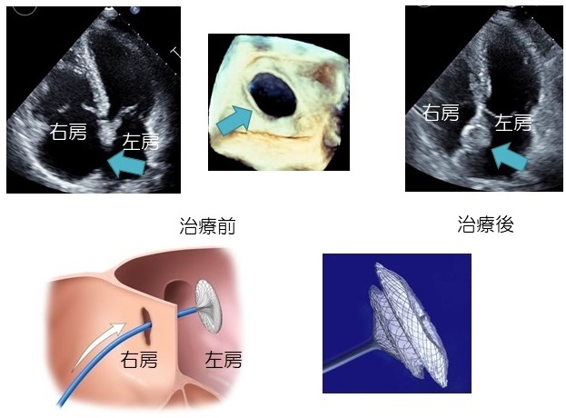 経皮的心房中隔欠損閉鎖術