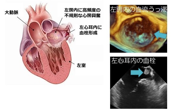 左心耳閉鎖システム