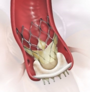 生体弁を折りたたみ収納されたカテーテルを大動脈まで送り込み、すでに植え込まれている外科生体弁の内側で新しい生体弁をゆっくりと展開させ留置します。