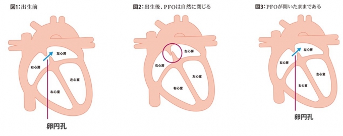 経皮的卵円孔開存閉鎖術