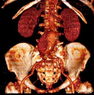 腹部大動脈瘤ステントグラフト治療01