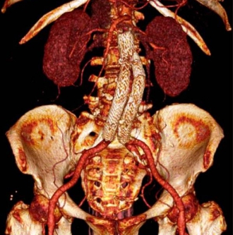 腹部大動脈瘤ステントグラフト治療02