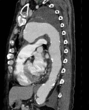 胸部大動脈瘤ステントグラフト治療01