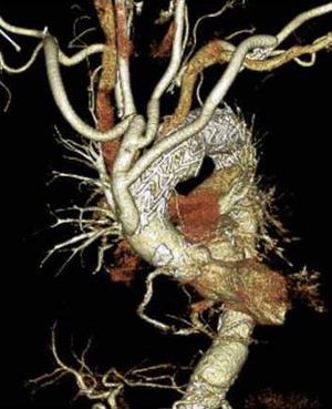 胸部大動脈瘤ステントグラフト治療02