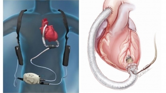 当院で管理可能な植込型補助人工心臓