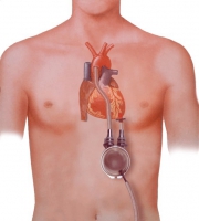 体外設置型の左室補助人工心臓