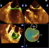 僧帽弁解析（mitral valve quantification:MVQ）