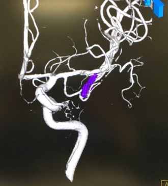 左内頚動脈造影（３D-DSA）
