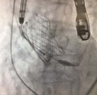 経カテーテル大動脈弁留置術 術中撮影