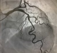 左冠動脈造影