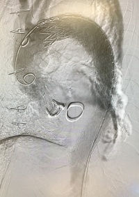 弓部大動脈造影（DSA）