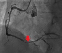 その後撮影した冠動脈造影。CTと同様、右冠動脈に高度狭窄を認める（矢印）。