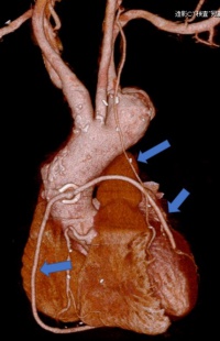 冠動脈バイパス術後。グラフとは3本とも開存している（矢印）。