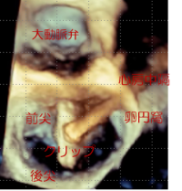 経皮的僧帽弁接合不全修復術