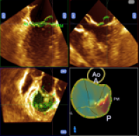 僧帽弁解析（mitral valve quantification:MVQ）