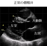 正常の僧帽弁
