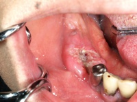 下顎歯肉癌
