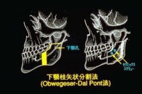 手術説明