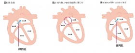 経皮的卵円孔開存閉鎖術