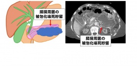 膵臓周囲の被包化壊死貯留